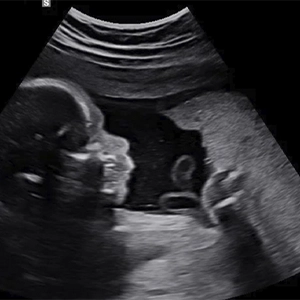 2D Ultrasound 2