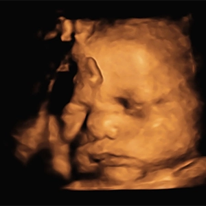 3D Ultrasound 3